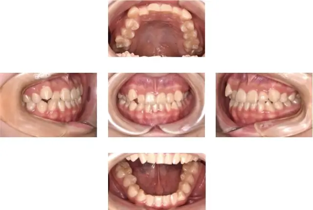 ガタガタ（叢生）治療例１３ 治療前