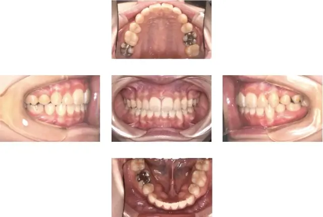 出っ歯（上顎前突）治療 ８ 治療後