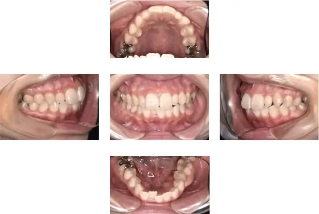 出っ歯（上顎前突）治療 ８ 治療前