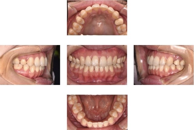 開咬の治療例 4 治療後