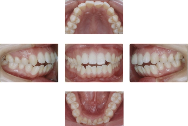 開咬の治療例 4 治療前