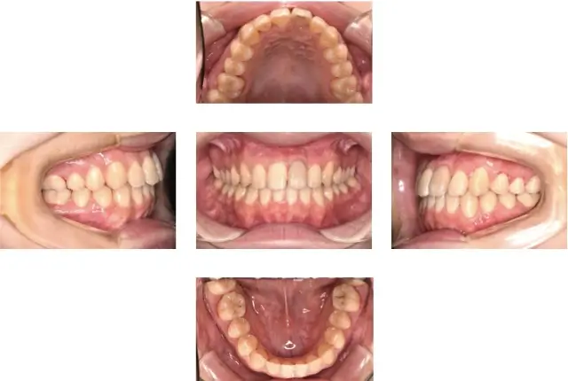 受け口（下顎前突）治療 7 治療後
