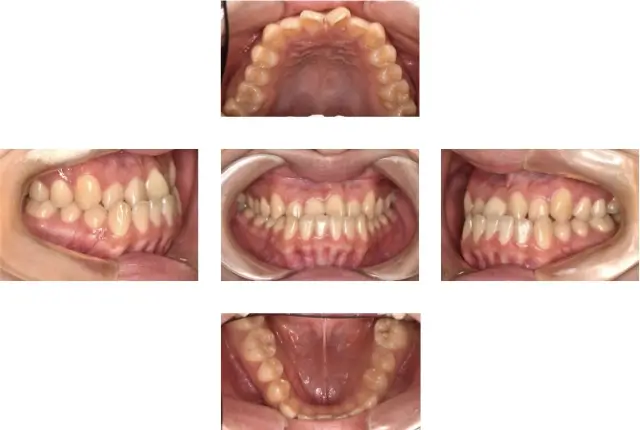 受け口（下顎前突）治療 7 治療前